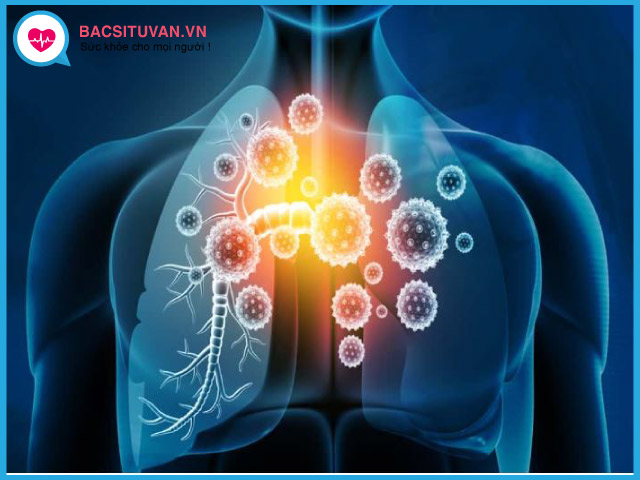 Các biến chứng của viêm phổi do virus có thể gặp