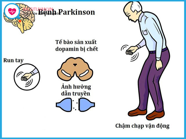 Nguyên nhân gây bệnh Parkinson là gì?