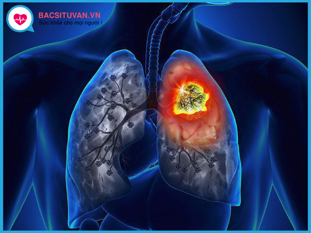 Bệnh ung thư phổi không tế bào nhỏ