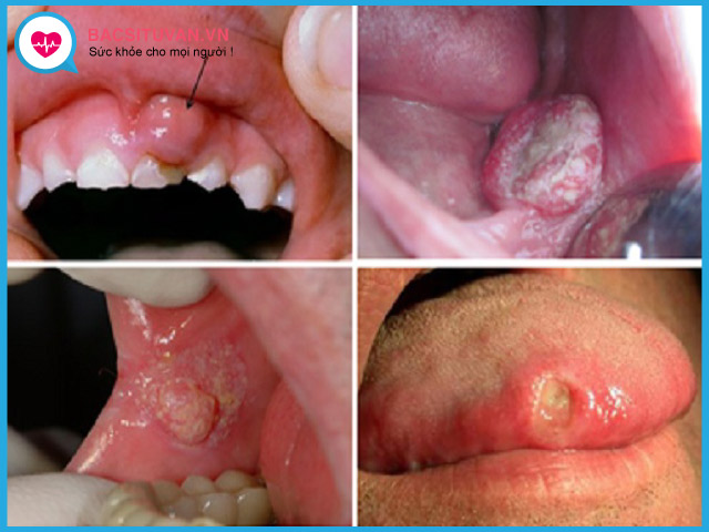 Các giai đoạn phát triển của ung thư miệng