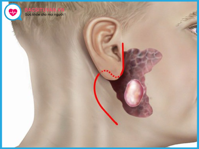 Dấu hiệu nhận biết ung thư tuyến nước bọt là xuất hiện khối u ở mang tai