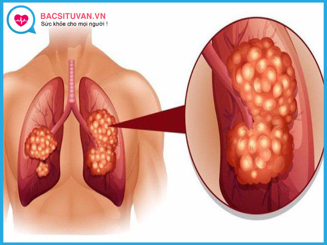 Nguyên nhân gây ung thư phổi không tế bào nhỏ