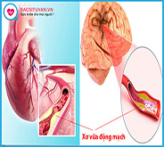 https://bacsituvan.vn/benh/cai-thien-mo-mau-cao-va-xo-vua-dong-mach-bang-omega-3-triglyceride-giau-epa