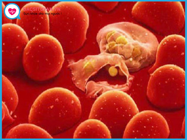 Bệnh thiếu máu do thiếu men G6PD có nguy hiểm gì cho sức khỏe không?