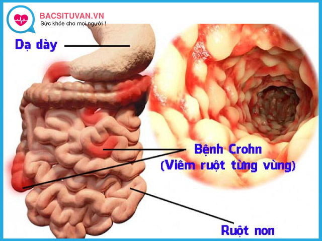Người mắc bệnh Crohn có thể là nguy cơ gây áp xe hậu môn trực tràng