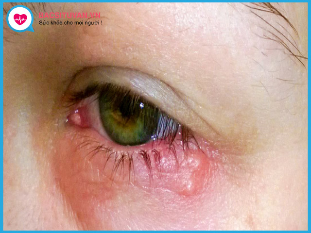 Bệnh nấm mắt là gì?