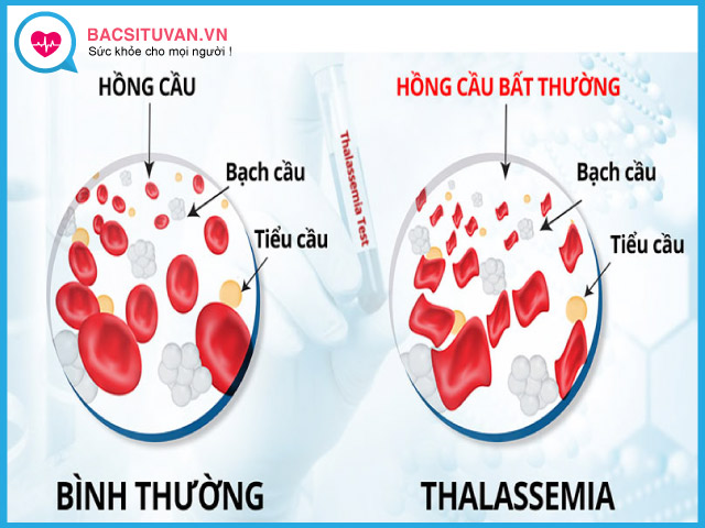 Bệnh thalassemia là gì?