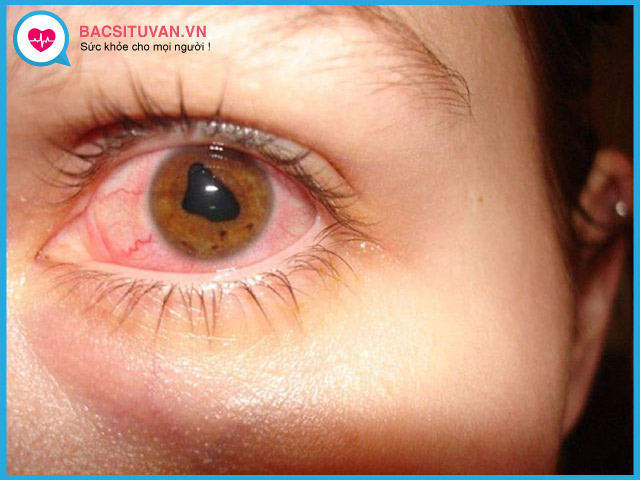 Biểu hiện triệu chứng của viêm mống mắt thể mi