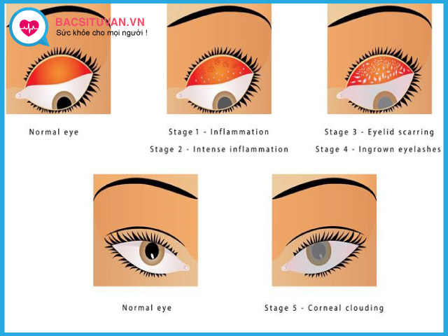 Các giai đoạn phát triển của đau mắt hột
