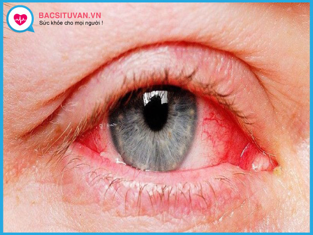 Nguyên nhân gây bệnh đau mắt đỏ