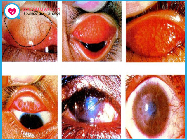Phân loại bệnh đau mắt hột