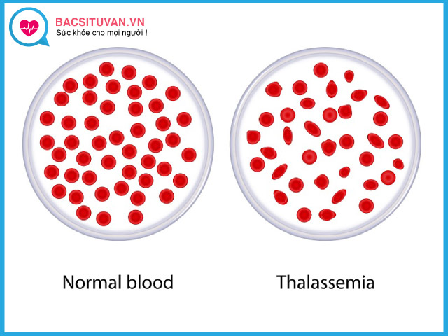 Phân loại mức độ bệnh thalassemia