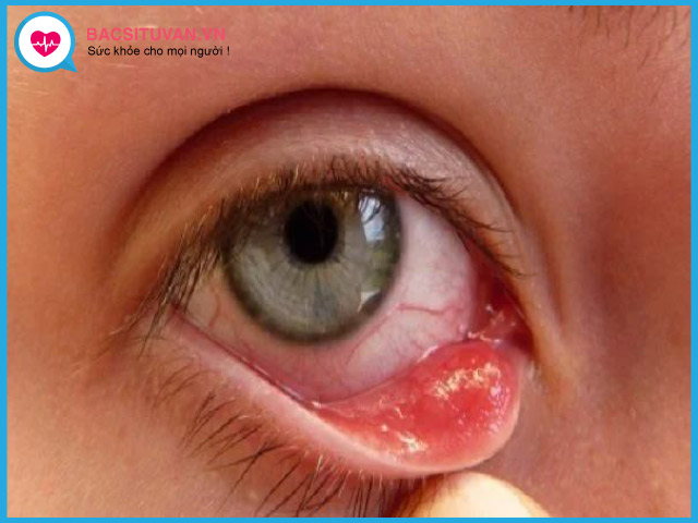 Tìm hiểu về bệnh đau mắt hột
