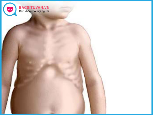 Bệnh còi xương thường gặp chủ yếu ở trẻ em
