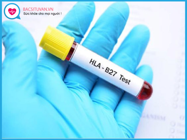 Xét nghiệm kháng nguyên hòa hợp mô HLA-B27