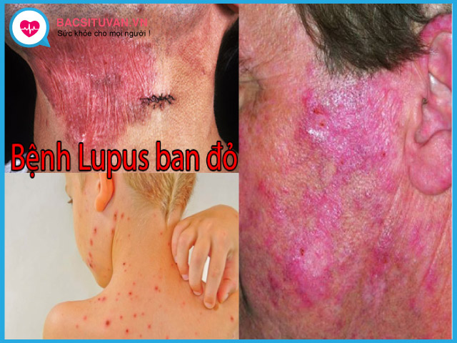 Các biến chứng của bệnh lupus ban đỏ