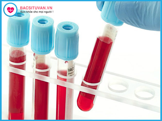 Xét nghiệm tế bào máu ngoại vi bệnh lupus ban đỏ