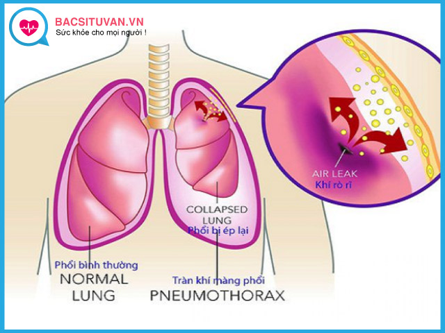 Bị xẹp phổi do tràn màng dịch phổi
