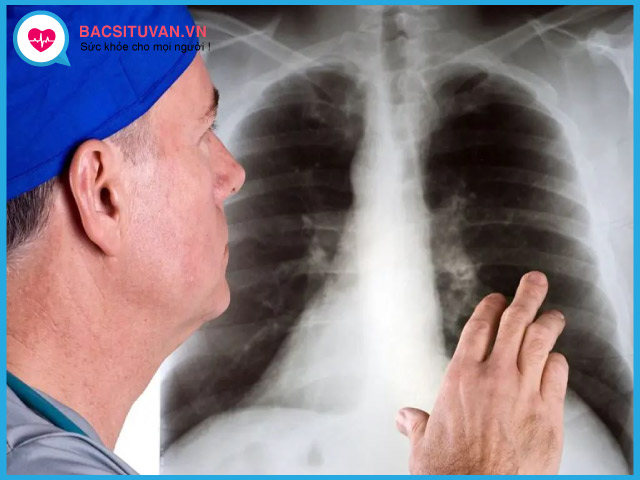 Chẩn đoán hình ảnh bệnh xơ phổi