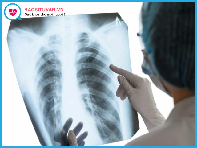 Chẩn đoán tràn khí màng phổi