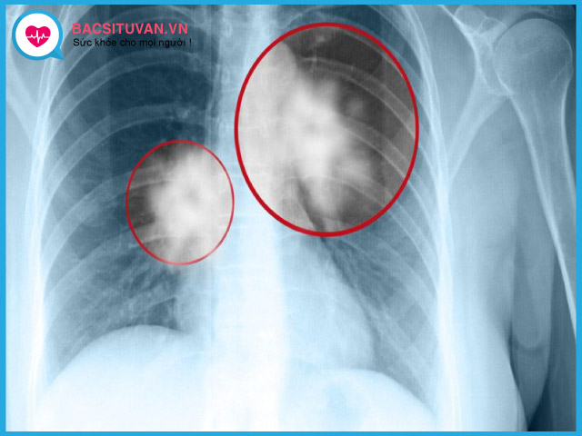Chẩn đoán viêm phổi do nấm bằng chụp x quang phổi