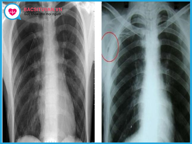 Chẩn đoán viêm phổi do tụ cầu