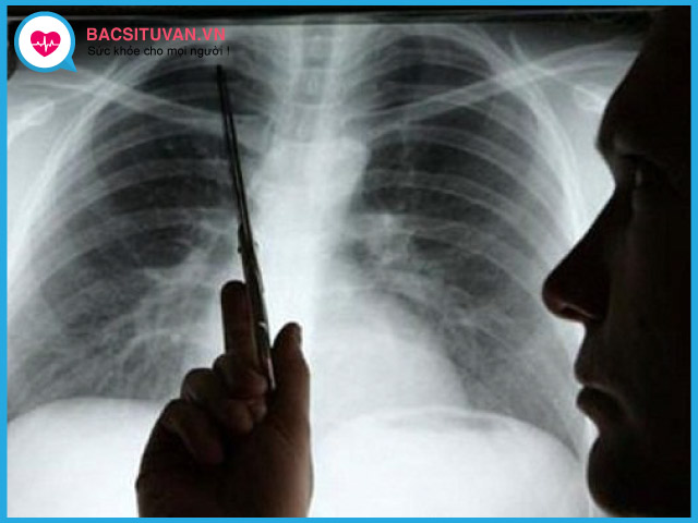 Chụp X-quang phổi chẩn đoán viêm phế quản cấp