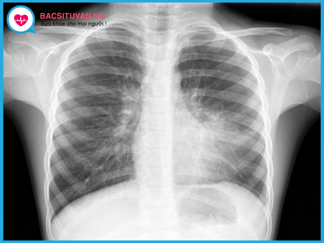 Chụp X-quang phổi chẩn đoán viêm phế quản mãn tính