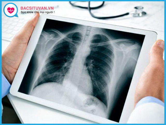Chụp x quang phổi để chẩn đoán bỏng hô hấp