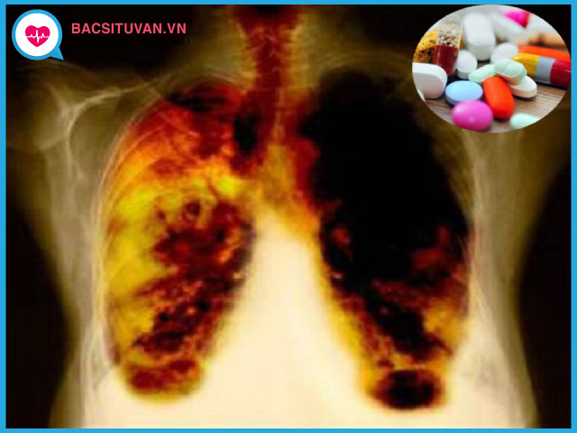 Điều trị bệnh bụi phổi silic