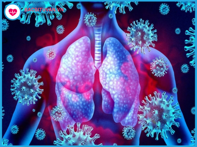 Nguyên nhân gây viêm phổi là do vi khuẩn, virus