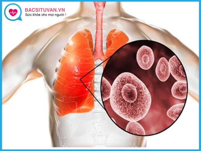 Những đối tượng có nguy cơ cao mắc viêm phổi do nấm