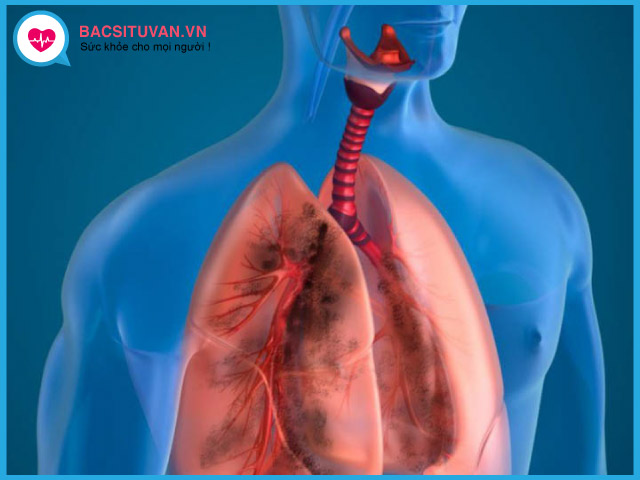 Phân loại bệnh bụi phổi silic