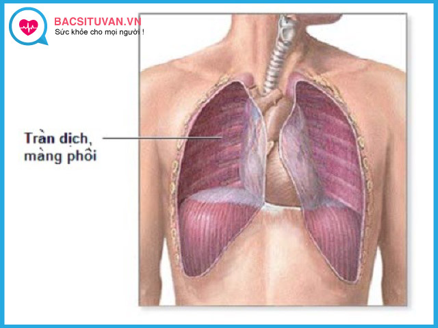 Phân loại tràn dịch màng phổi