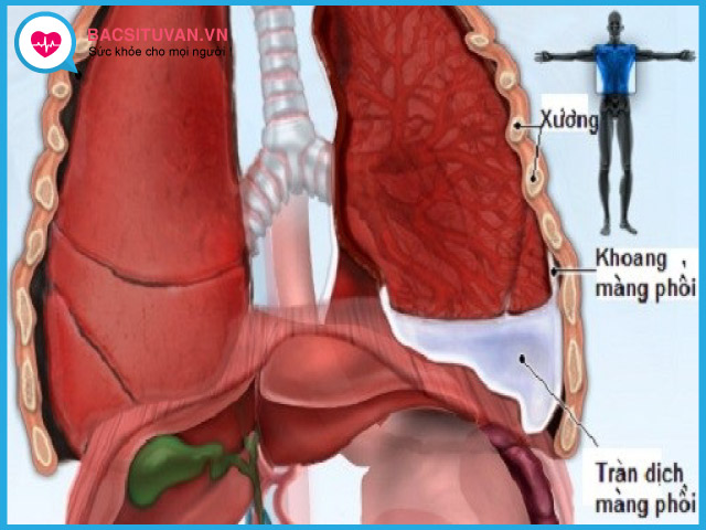 Tìm hiểu về bệnh tràn dịch màng phổi