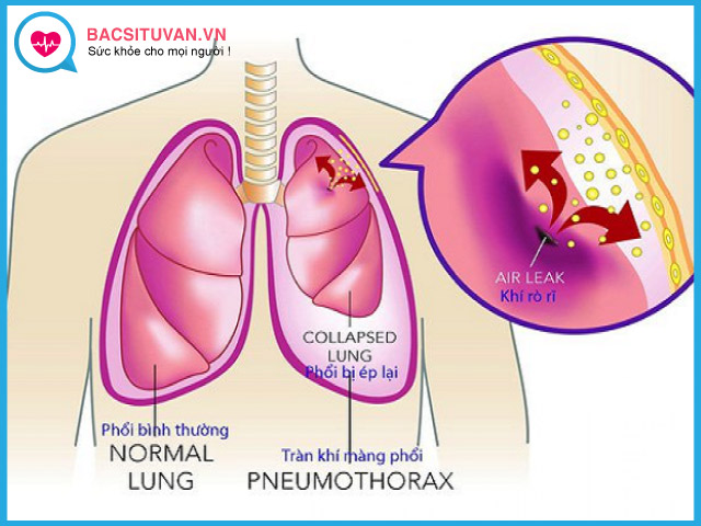 Tìm hiểu về bệnh tràn khí màng phổi