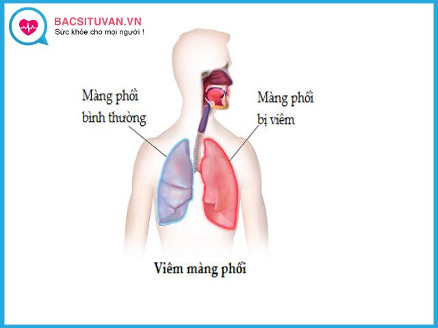 Tìm hiểu về bệnh viêm màng phổi