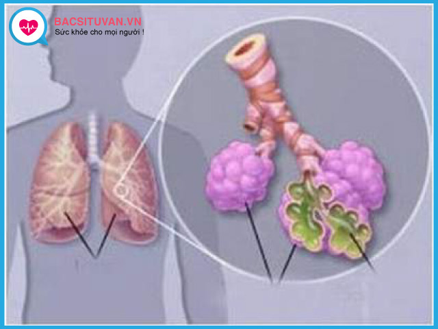 Tìm hiểu về bệnh viêm phổi do tụ cầu