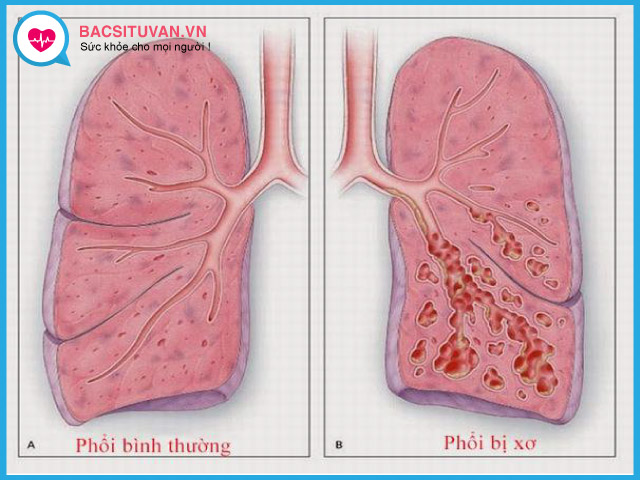 Tìm hiểu về bệnh xơ phổi