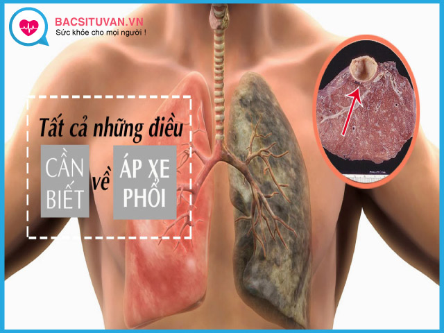 Tổng quan về bệnh áp xe phổi