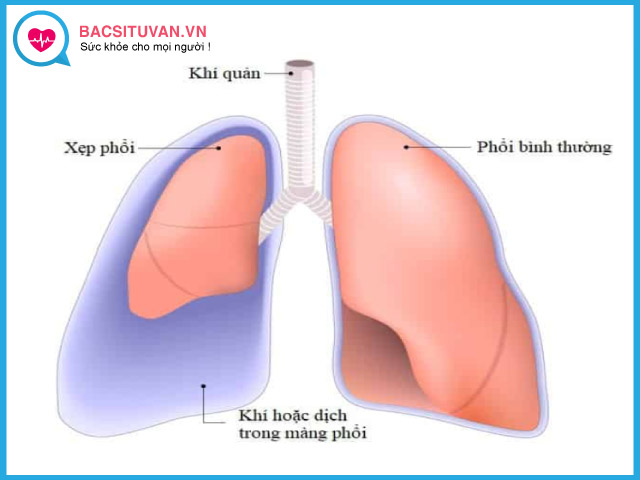 Tổng quan về bệnh xẹp phổi