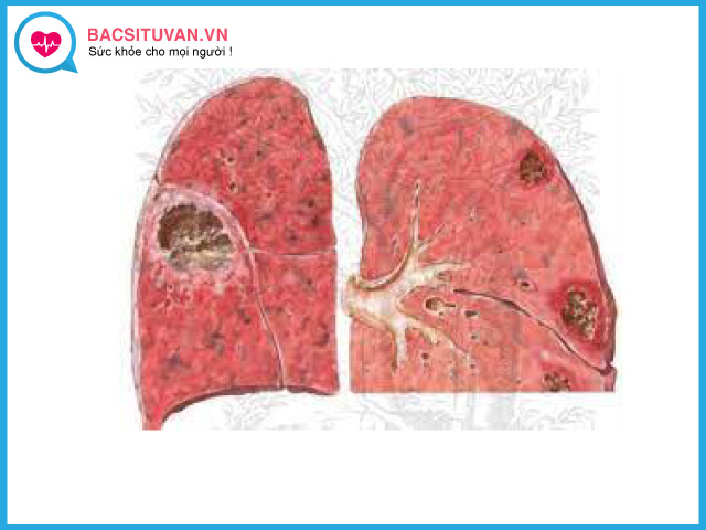 Viêm phổi kẽ