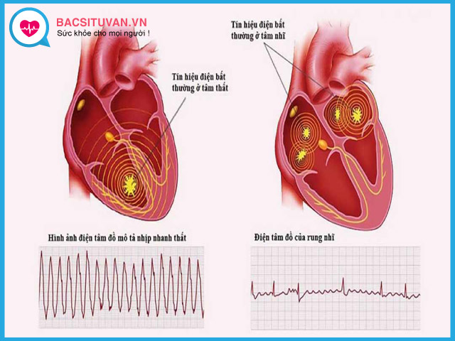 Một số loại rối loạn nhịp tim thường gặp
