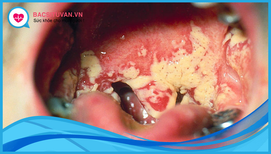 Nguyên nhân gây nấm miệng do nấm Candida albicans
