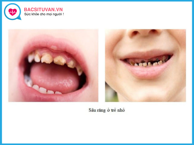 Các vấn đề về răng sữa trẻ thường gặp phải