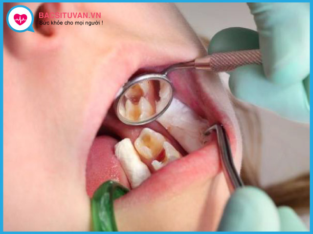 Chẩn đoán viêm tủy răng có hồi phục