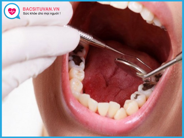 Chẩn đoán viêm tủy răng không hồi phục