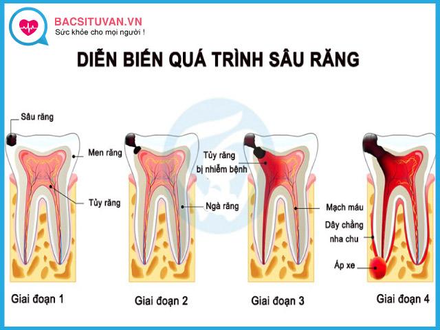 Diễn biến của bệnh sâu răng
