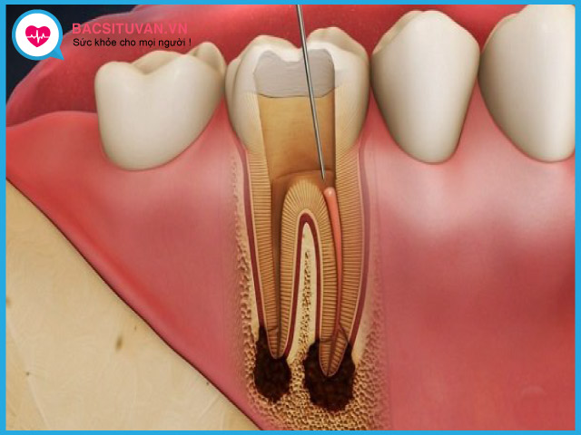 Nguyên nhân gây viêm tủy răng