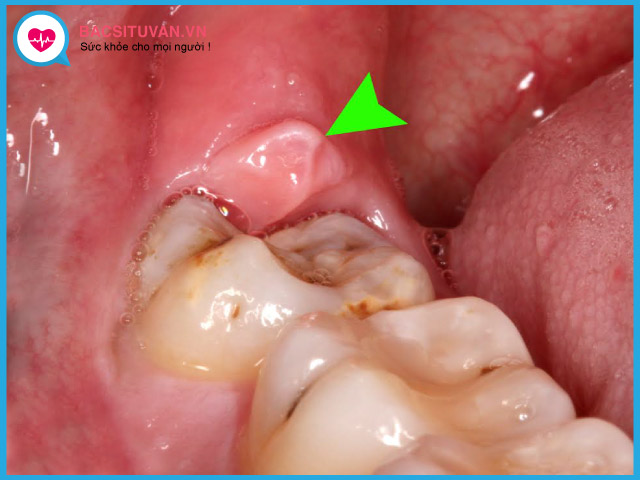 Triệu chứng thường gặp của răng mọc kẹt